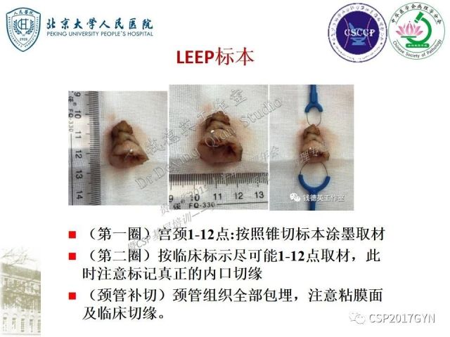 中华病理学会基层培训遵义站讲座（三）——宫颈鳞状上皮病变的病理诊断与鉴别诊断