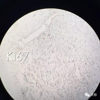 High grade nested variant Urothelial carcinoma(老胡分享，孔祥田老师讲解)