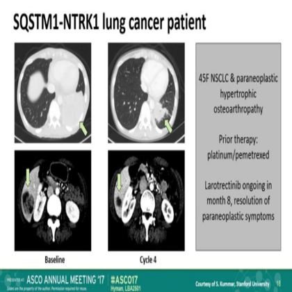 The efficacy of LOXO-101,a selective TRKI, in adult and pediatric TRK fusion cancers