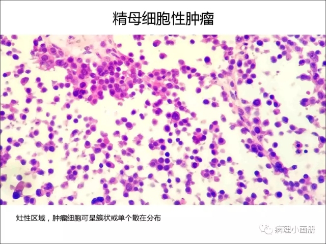 泌尿病理--精原细胞瘤VS精母细胞瘤