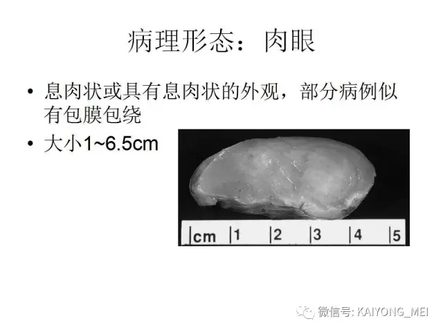女性生殖道软组织肿瘤病理诊断及进展（一）