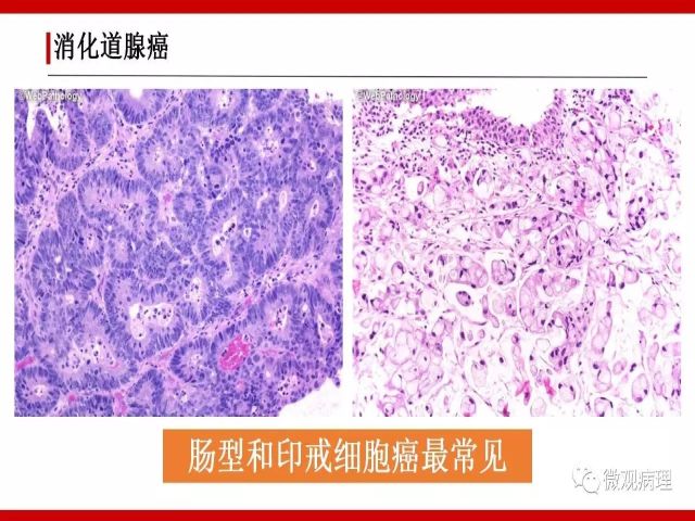 泌尿课程/尿路腺样病变的诊断要点