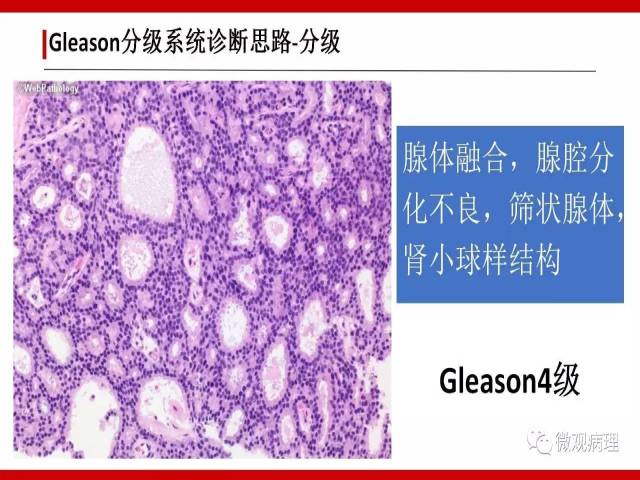前列腺癌Gleason分级系统的前世今生