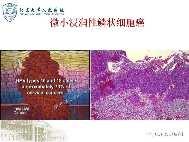 中华病理学会基层培训遵义站讲座（三）——宫颈鳞状上皮病变的病理诊断与鉴别诊断