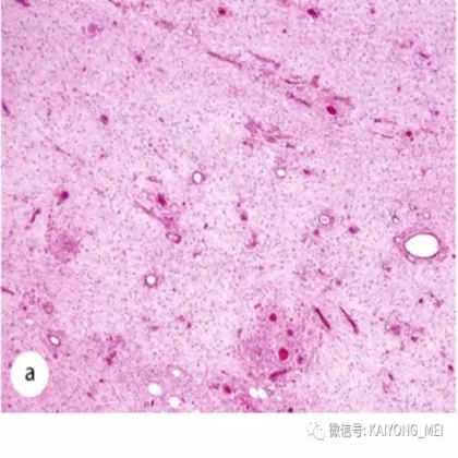 女性生殖道软组织肿瘤病理诊断及进展（二）