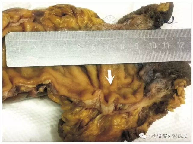 直肠癌新辅助治疗后病理评估