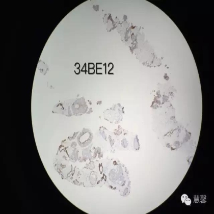 孔祥田(Max)*Roswell*NM老师分享前列腺癌病例
