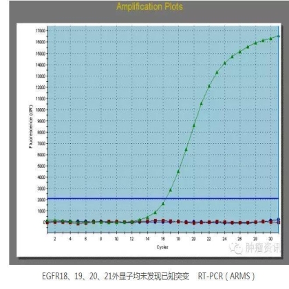 中日韩个体化诊疗案例大赛经典赏析之十二——胸水细胞RT-PCR检测ALK融合，更高效识别突变患者