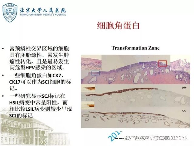 宫颈鳞状上皮内病变病理诊断中问题