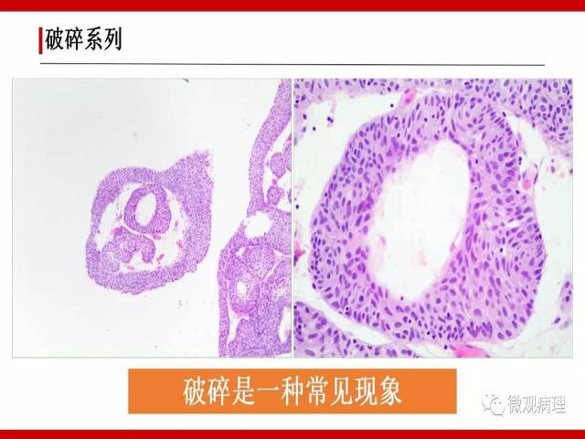 泌尿课程/非浸润性尿路上皮病变诊断的一些困惑