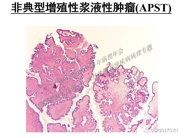 中华病理学会基层培训遵义站讲座（一）——卵巢和输卵管浆液性肿瘤的诊断和鉴别诊断