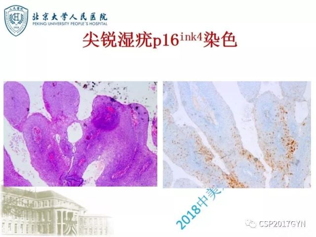 宫颈鳞状上皮内病变病理诊断中问题