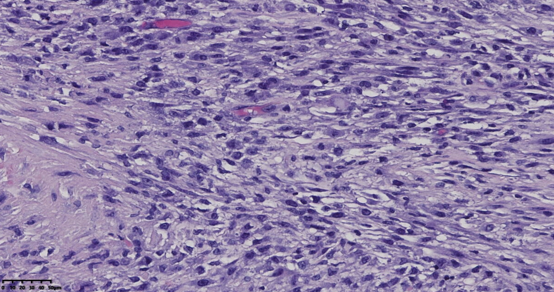子宫多发性平滑肌瘤伴肉瘤