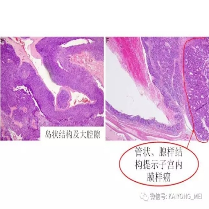 卵巢癌的病理诊断新进展（二）