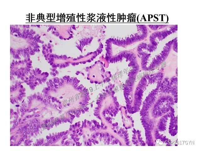 中华病理学会基层培训遵义站讲座（一）——卵巢和输卵管浆液性肿瘤的诊断和鉴别诊断