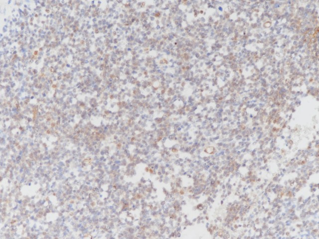 肌源性肉瘤临床病理学研究进展：从一个病例说起（一）