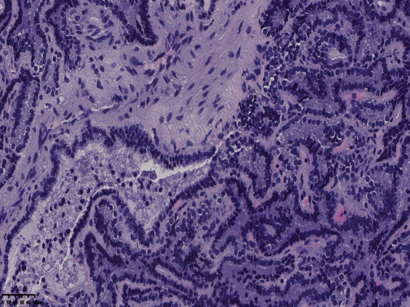 这个甲状腺肿瘤怎么看？