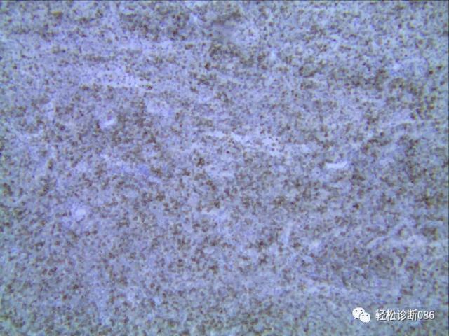 滤泡辅助T细胞（TFH）及其相关淋巴瘤（12）
