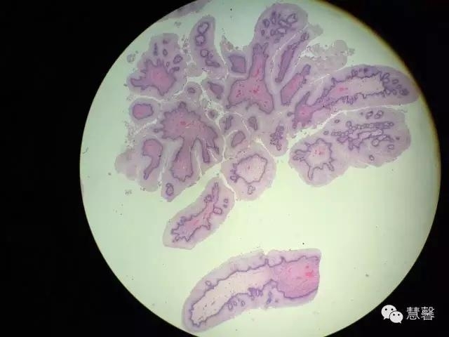 阴道鳞状上皮乳头状瘤？尖锐湿疣？（孔祥田老师病例分享，粉蓝医疗科技（杭州）有限公司女性生殖2群讨论，孔祥田(Max)*Roswell*老师讲解）