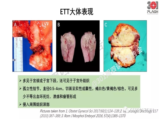 中间型滋养细胞肿瘤的诊断及鉴别诊断