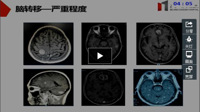黑色素瘤脑转移药物治疗进展