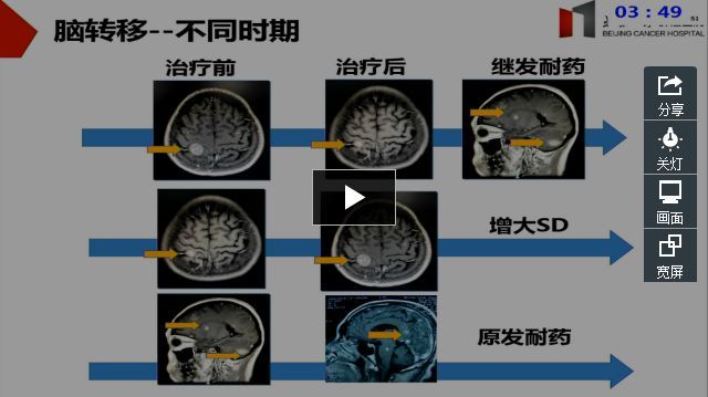 黑色素瘤脑转移药物治疗进展