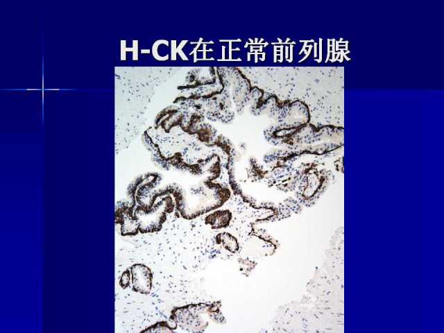 前列腺病理诊断线索（上）——黄教悌
