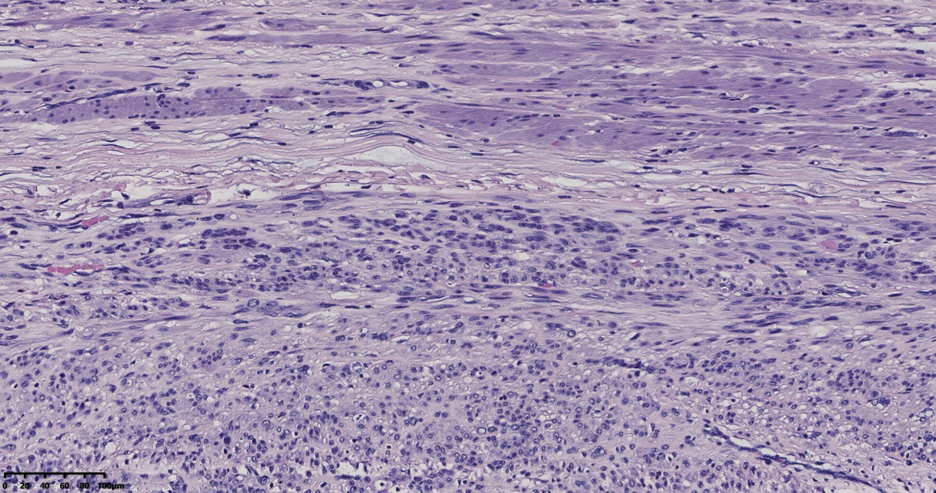 子宫多发性平滑肌瘤伴肉瘤