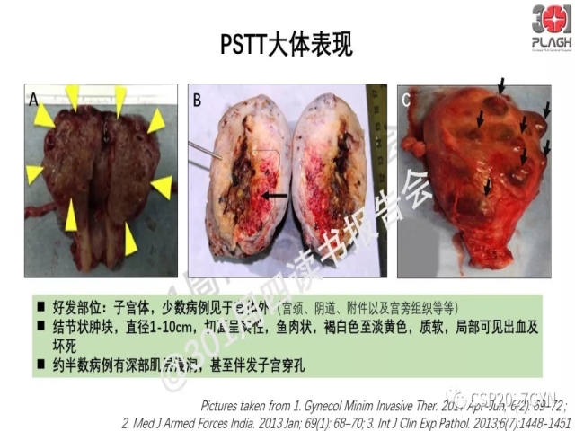 中间型滋养细胞肿瘤的诊断及鉴别诊断