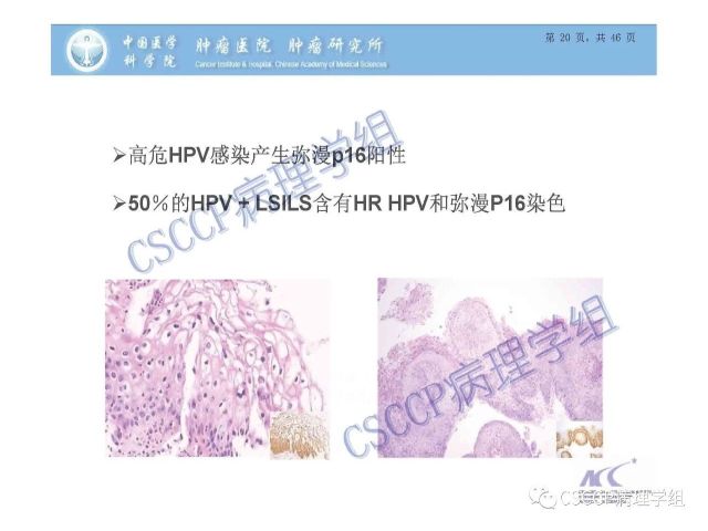 宫颈癌前病变中的诊断难点及阴道镜中ECC的 应用价值