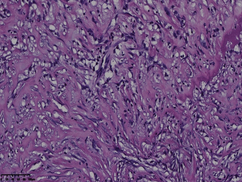 睾丸鞘膜肿物伴鞘膜积液