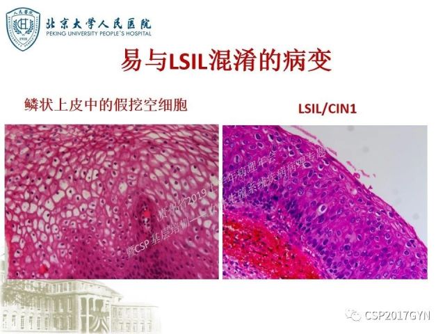 中华病理学会基层培训遵义站讲座（三）——宫颈鳞状上皮病变的病理诊断与鉴别诊断