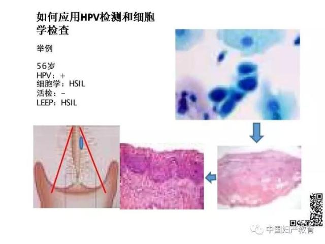 独家专访国内妇产科病理大咖周先荣教授：子宫颈上皮内病变及相关临床情况的若干病理学问题（一）