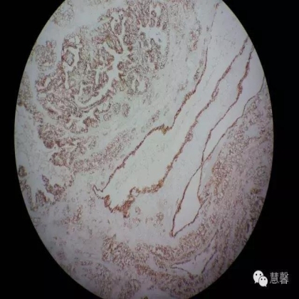 透明细胞乳头状肾细胞癌？TFE3 Traslocation Carcinoma？（赵洋分享，孔祥田(Max)*NM老师讲解）