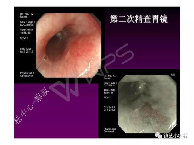 上消化道早癌病理的学习心得体会（附胃牵手癌的病例特点文献学习）