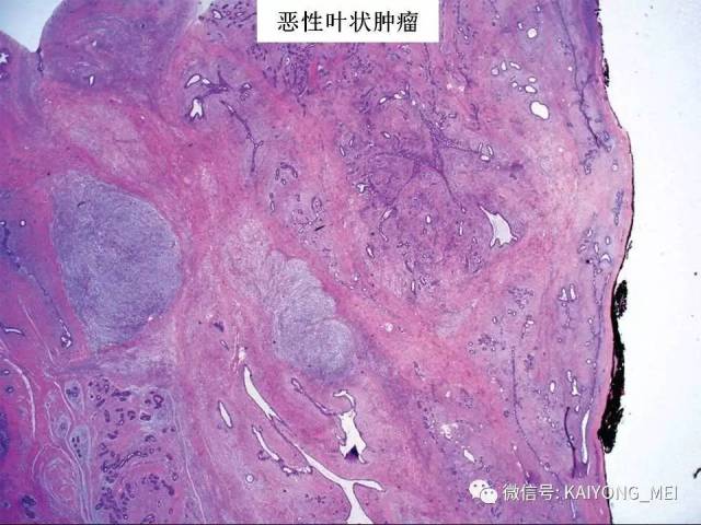 乳腺梭形细胞病变的病理诊断及进展（二）