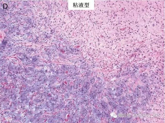 乳腺梭形细胞病变的病理诊断及进展（一）