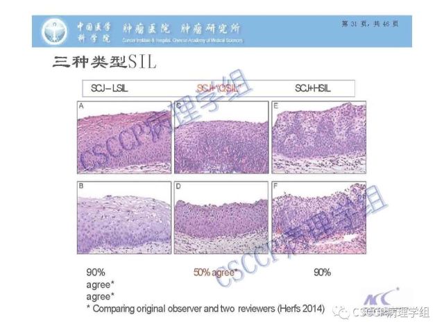 宫颈癌前病变中的诊断难点及阴道镜中ECC的 应用价值