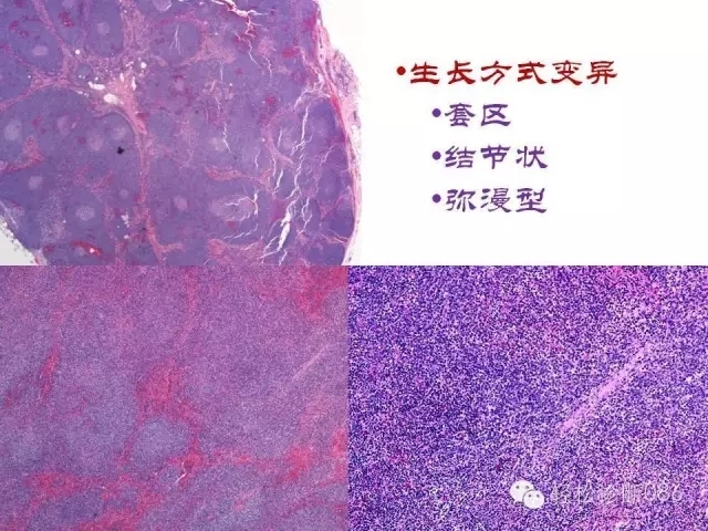 关于套细胞淋巴瘤的总结课件