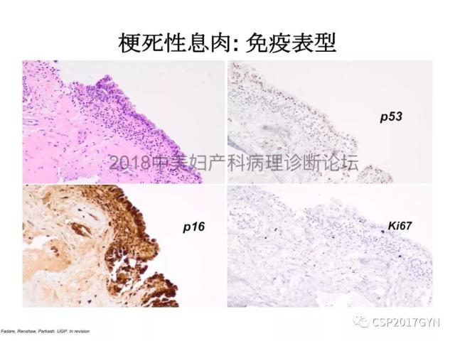 子宫内膜假肿瘤性病变及类似癌样病变