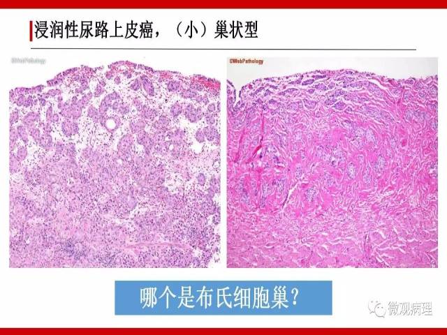 泌尿课程/浸润性尿路上皮癌病理学类型