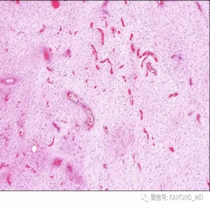 女性生殖道软组织肿瘤病理诊断及进展（二）