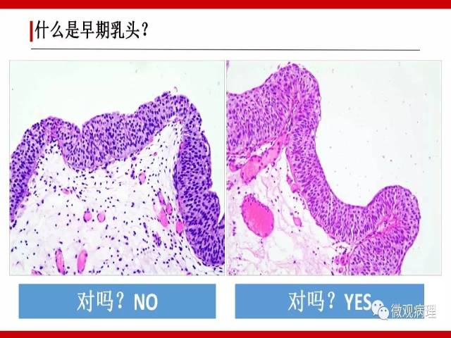 泌尿课程/尿路上皮病变的基本生长方式