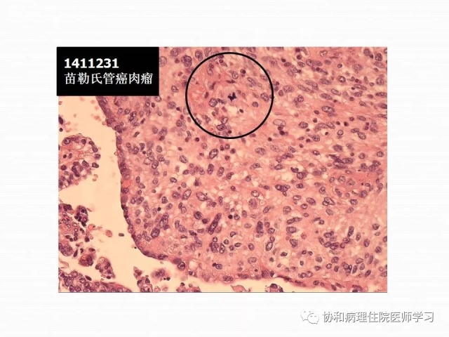 病理学基础知识 : 核分裂像的识别