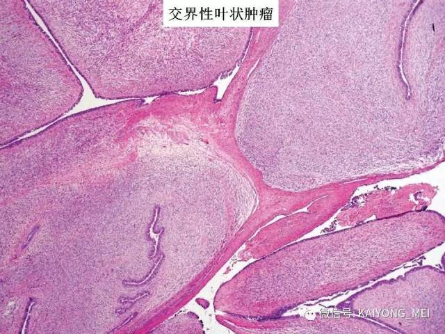 乳腺梭形细胞病变的病理诊断及进展（二）