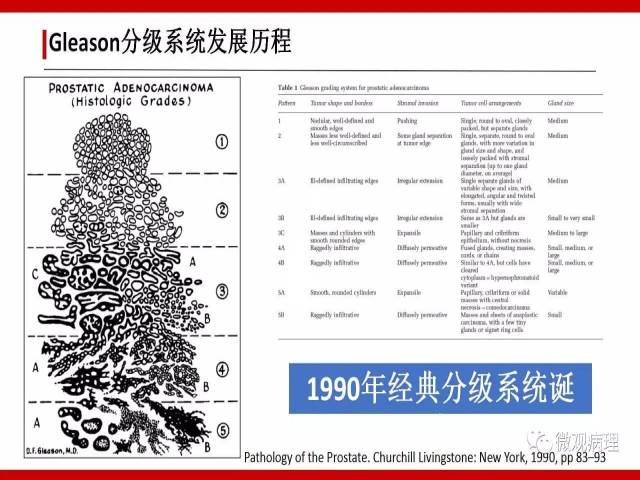 前列腺癌Gleason分级系统的前世今生