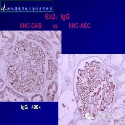 探讨免疫组织学在肾穿标本中的应用