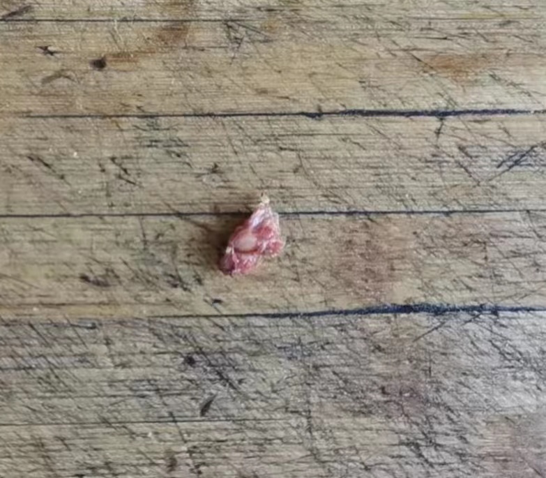 不典型的甲状腺乳头状癌？（札记八十）