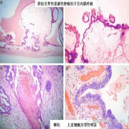 卵巢癌的病理诊断新进展（二）