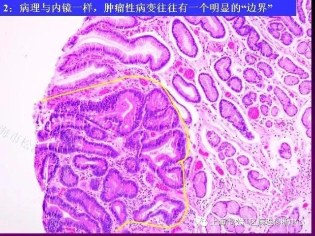 上消化道低级别上皮内瘤变的那些事